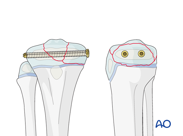 Screw fixation of a Salter-Harris type-III fracture of the proximal tibia