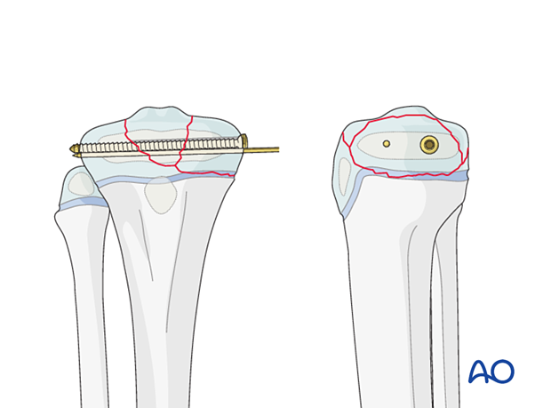 Screw and K-wire fixation of a Salter-Harris type-III fracture of the proximal tibia