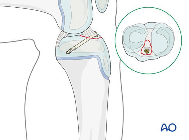 extraarticular fracture avulsion of tibial spine