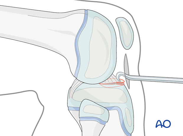 p41 P220 Arthroscopically assisted screw fixation