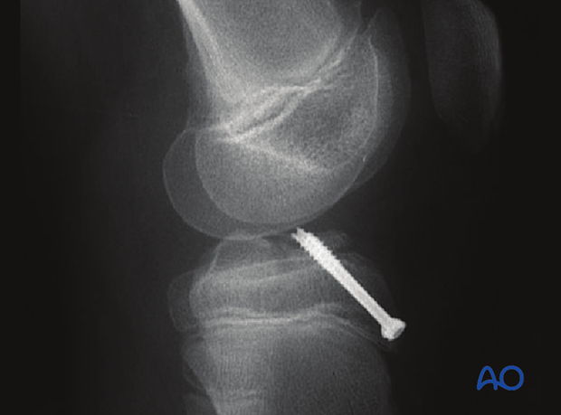 Reduction of the fragment with arthroscopy and an image intensifier and tension of the ACL