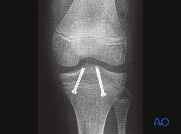 p41 P220 Arthroscopically assisted screw fixation