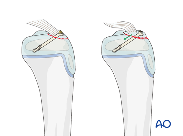 Antegrade screw is perpendicular to the line of action of the ACL