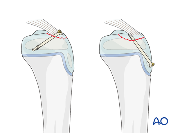 Displaced avulsion fractures of the tibial spine