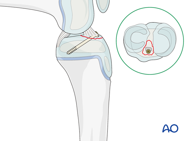 extraarticular fracture avulsion of tibial spine