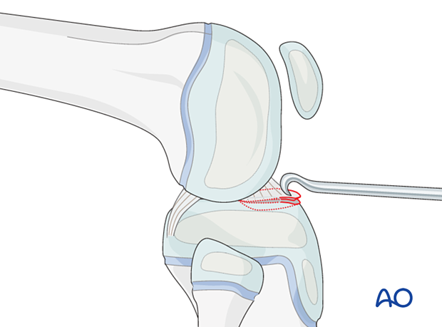 Reduce the spine fragment with a hook