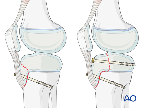 Displaced fractures, quadriceps force, patellar tendon, open reduction. Smaller fragments, tension band fixation. Surgery goals: reattach avulsed fragment, anatomical reduction, soft-tissue reconstruction.