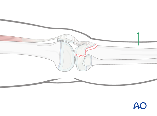 Hyperextending the knee