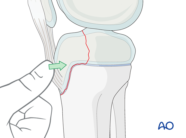 Reduce fracture, direct pressure, manipulate fragment, correct position