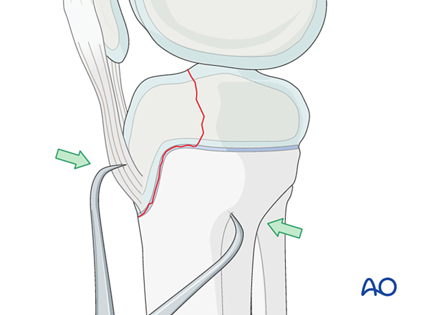 Small reduction forceps placed on the anterior tibial cortex and the bone fragment