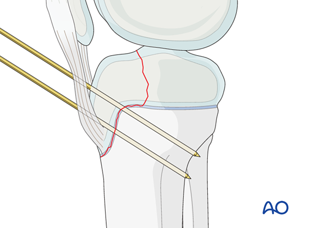 Temporary K-wires