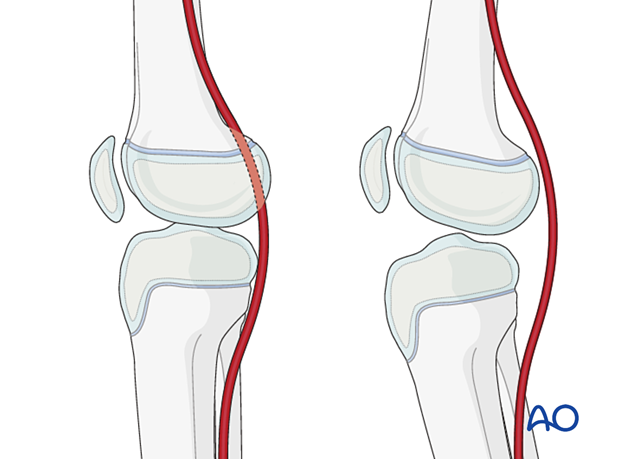 Neurovascular bundle is closely related to the bone in full extension