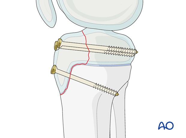 Lag screw insertion