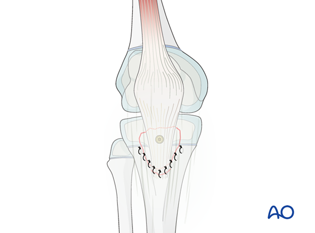 Soft-tissue reconstruction