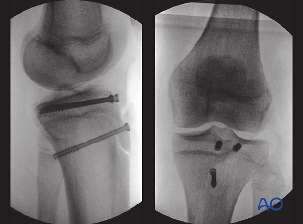 Fragment, implant position, tension, patellar tendon, direct vision, image intensifier.