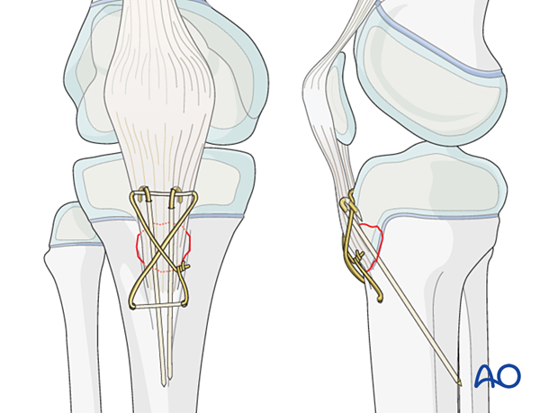 Displaced fractures, quadriceps, patellar tendon, open reduction. Unstable fixation, small fragments, cerclage wiring.