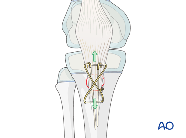 Cerclage wire counteracts quadriceps pull. Strong wire withstands tensile forces. Figure-of-eight loop