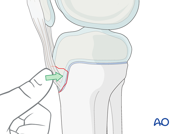 Reduce the fracture manually or with a small reduction forceps