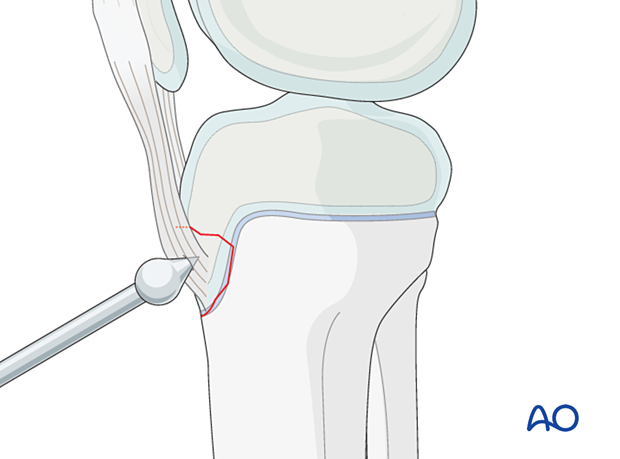 Reduction may additionally be secured by temporary K-wires.