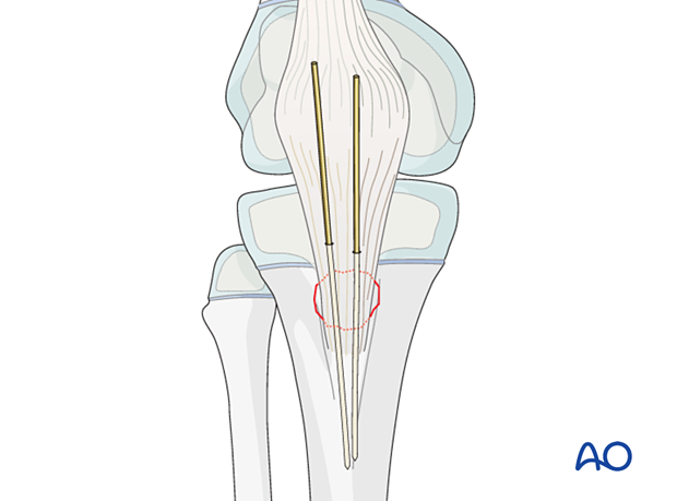 Insert two parallel K-wires through the proximal part of the tibial tuberosity