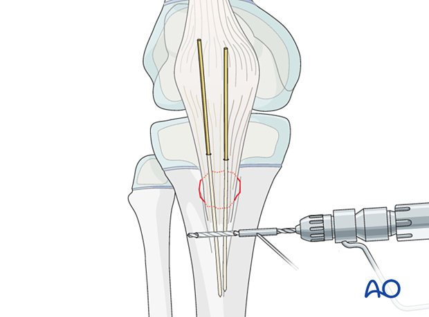 Drill a horizontal hole through the tibial crest, distal to the apophysis.