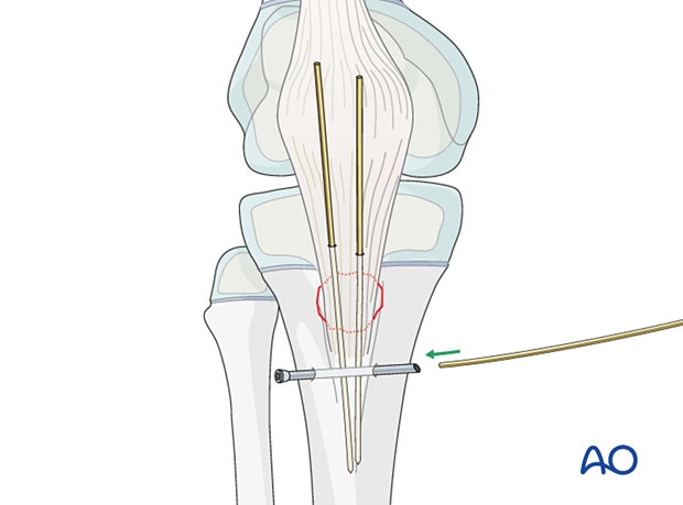 Pass a cerclage wire through the drill hole with a suture passer.