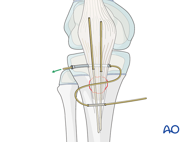 Insert the wire through the fibers at the insertion of the patellar tendon in the tibial tuberosity