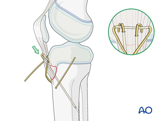 Check the position of the K-wires using image intensification