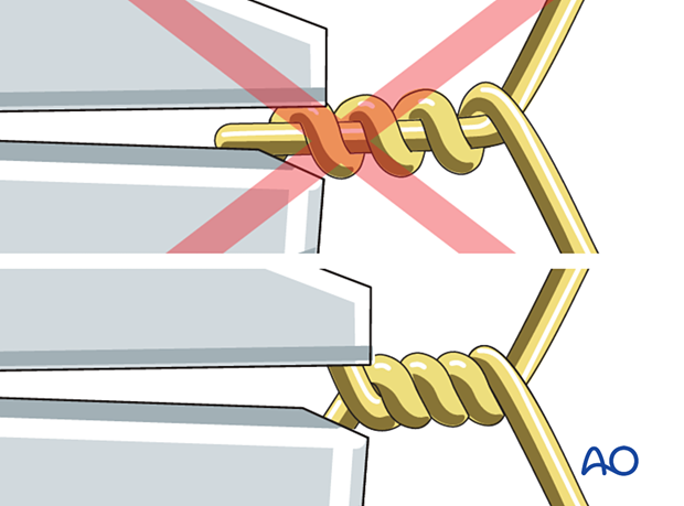 Reduce fragment, tighten wire loop, cut short, bend to avoid irritation. Twist both wire ends together, not one around the other.