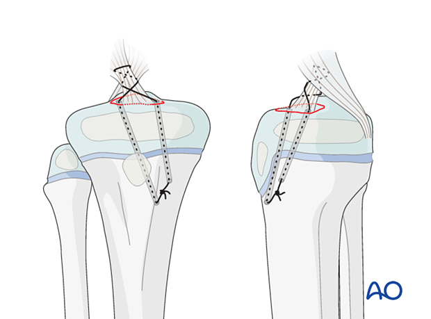 Internal fixation tibial spine fractures, suture through bone tunnels, arthroscopic reduction, ACL tension restoration, no implant removal.