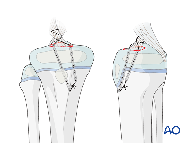 Left Tibia Fixation Suture fixation for Avulsion of the tibial spine