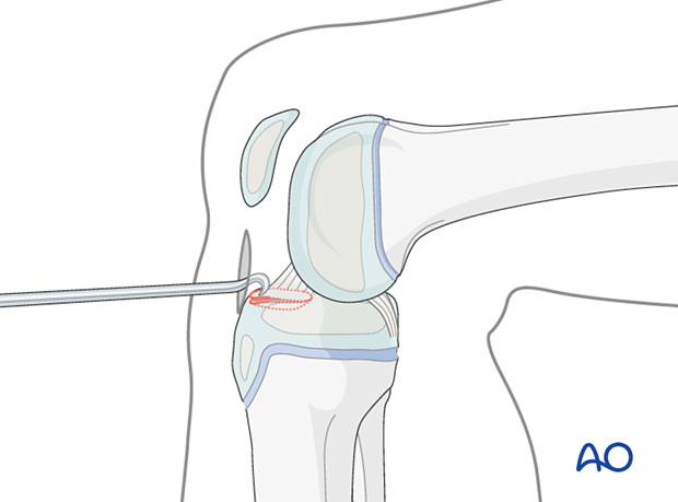 Reduce spine fragment with hook, tension suture band for final reduction, ensure no ligament trapping.