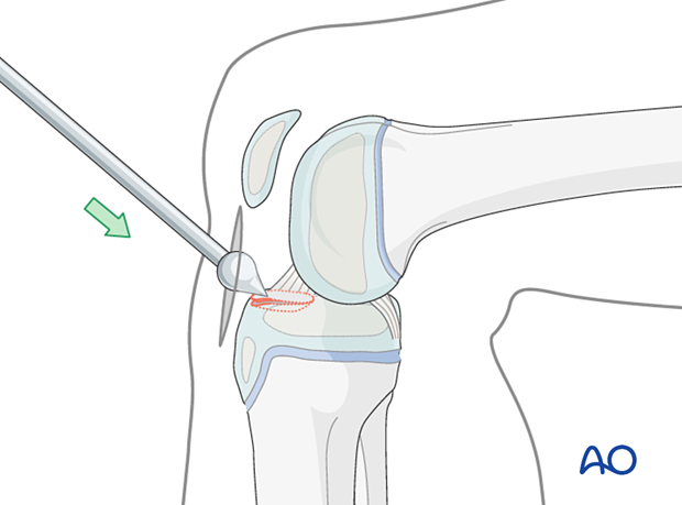 Reduce fragment with hook/pusher, confirm visually or with image intensifier.