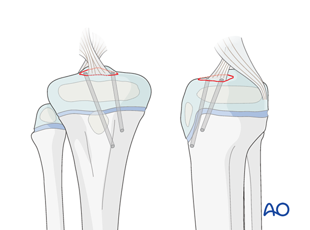 Cannulated drill over K-wire to create two holes from proximal medial tibia into tibial spine fragment.