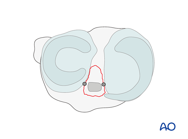 Drill holes ideally exit medial and lateral to ACL base.