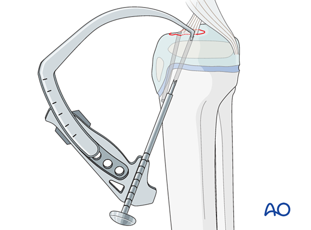 ACL drill guide system aids precise hole positioning and fracture reduction.