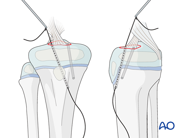 Pass fiber wire or PDS (size 0) retrograde through one drill hole; use suture passer.