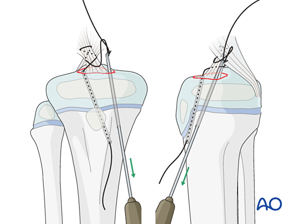 Pass suture through ACL multiple times, use retrograde lasso to capture and pass through second hole.