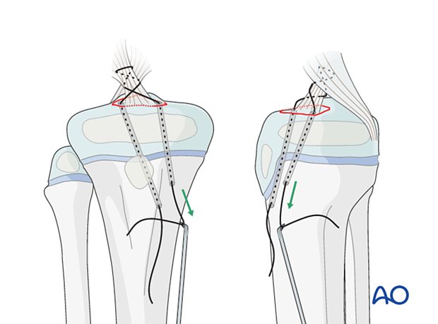 Pull sutures to tighten the ligament.