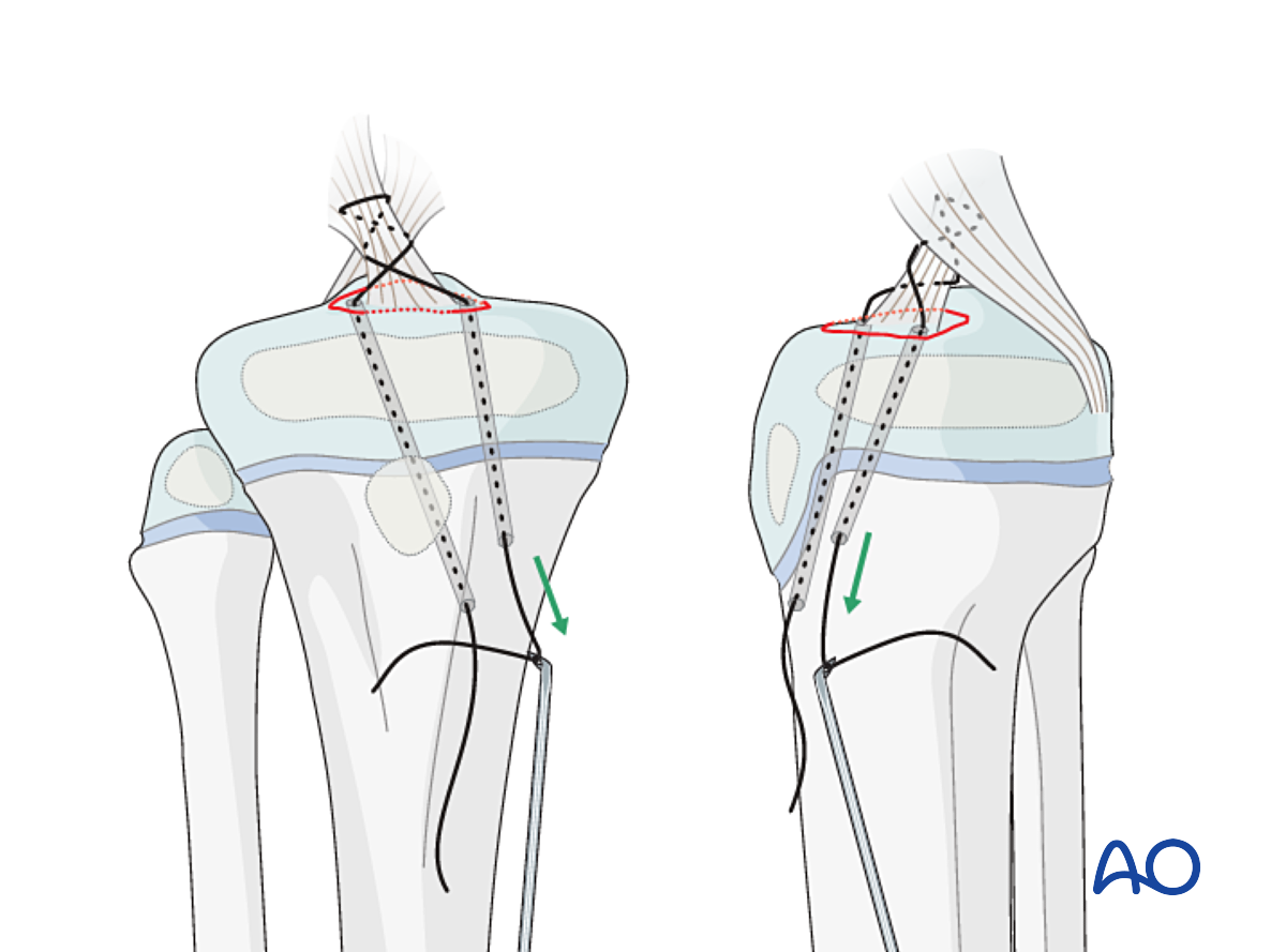 Suture Fixation For Avulsion Of The Tibial Spine Suture Fixation For Avulsion Of The Tibial Spine