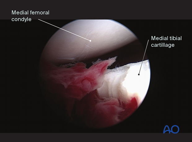 Arthroscopic views tibial spine avulsion