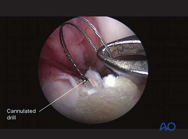 Suture lassos inserted through cannulated drill into joint for passing suture (fiber wire)