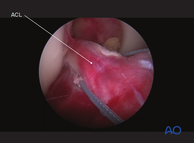 Fiber wire inserted through base of ACL