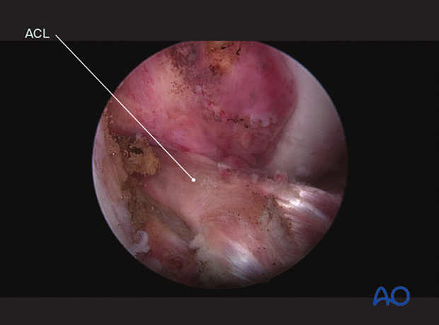 Reduced tibial spine fragment and ACL under tension