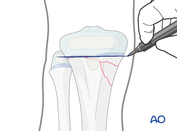 Marking the proximal tibial physis on the skin before open reduction and fixation of a multifragmentary Salter-Harris type-II fracture