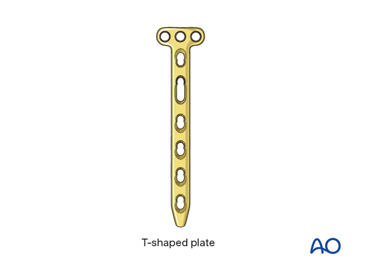 Open Reduction - Plate Fixation For Complete Metaphyseal And Greenstick ...