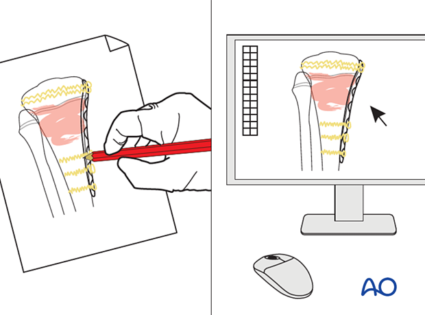 Preoperative planning for plate fixation of a proximal tibial fracture