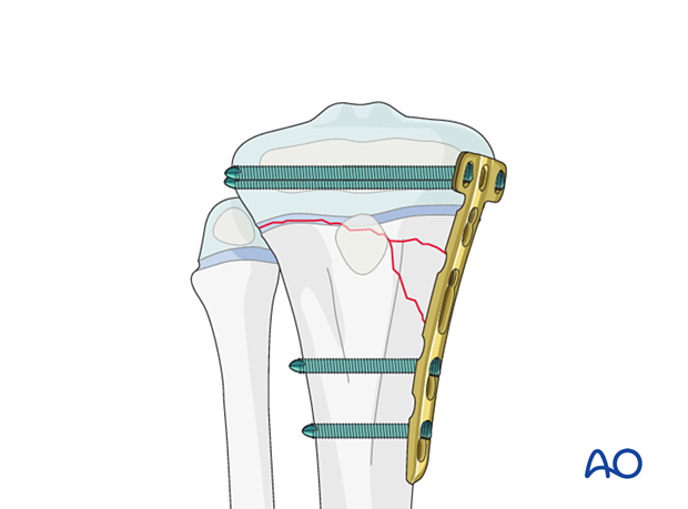 Open reduction and plate fixation of a Salter-Harris type-II proximal tibial fracture