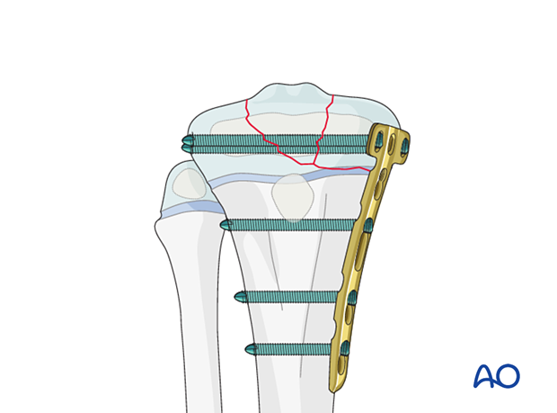 Open reduction and plate fixation of a multifragmentary Salter-Harris type-III proximal tibial fracture