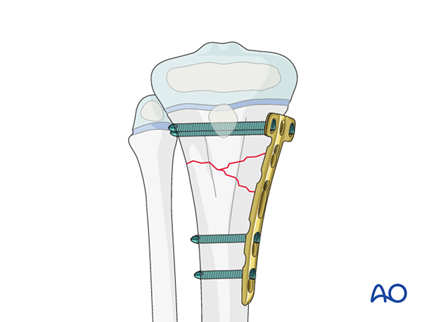 Open reduction and plate fixation of a Salter-Harris type-II proximal tibial fracture